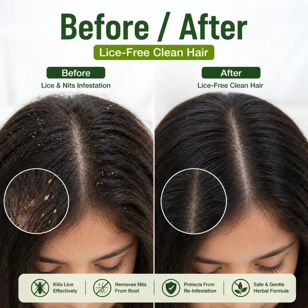 Anti Lice Oil - Advanced Herbal Lice Removal Formula